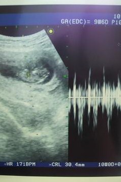 妊娠検査薬の陽性