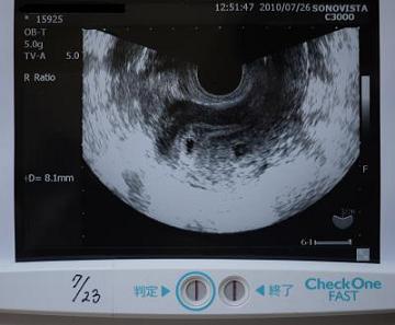 妊娠検査薬の陽性写真とエコー写真