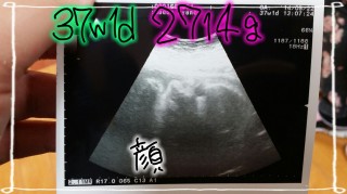 エコー写真