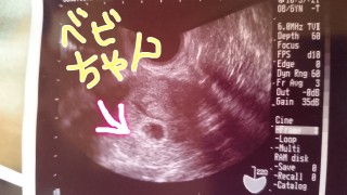 エコー写真