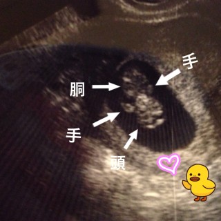 エコー写真