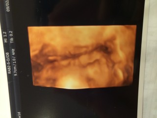 エコー写真