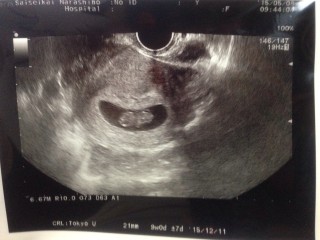 エコー写真