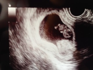 エコー写真