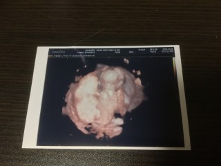 エコー写真