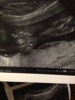 エコー写真