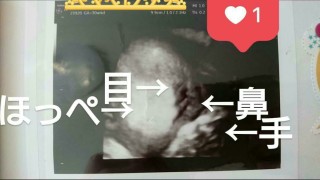 エコー写真