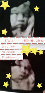 エコー写真