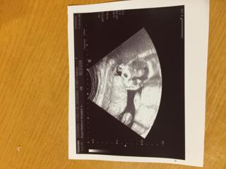 エコー写真