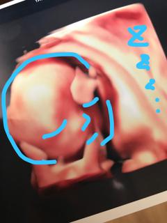 エコー写真