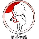 臍帯巻絡
