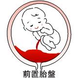 前置胎盤