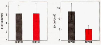 腹腔鏡下卵巣焼灼術